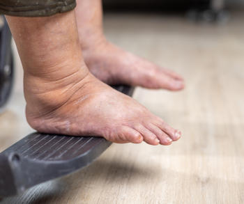 Helping Seniors Understand Edema